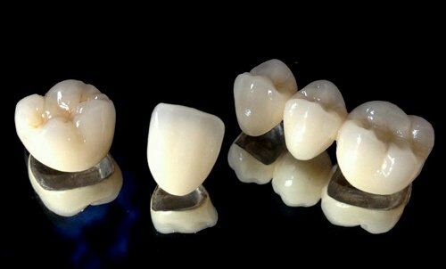 Cách chăm sóc răng sứ kim loại đúng cách