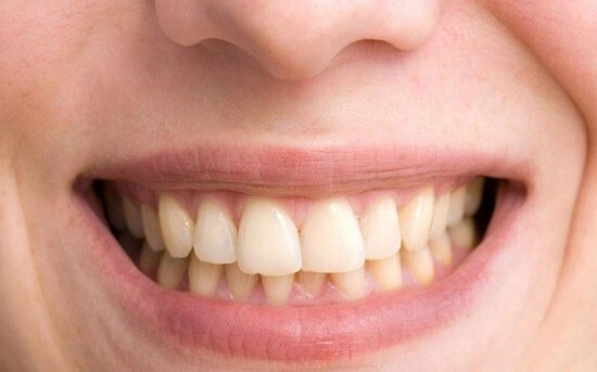 Cách điều trị răng bị nhiễm màu do yếu tố nội sinh 1