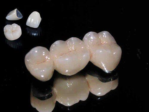 Cách nhận biết răng sứ Titan