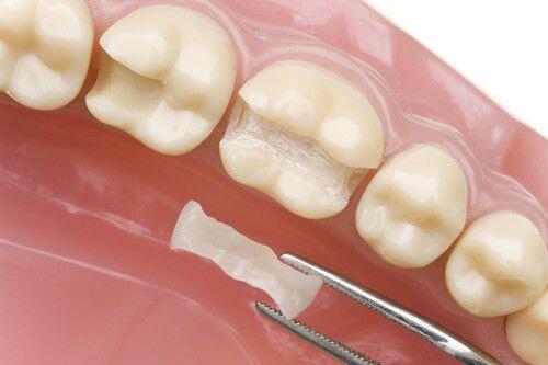 cách phòng ngừa răng bị mòn mặt nhai