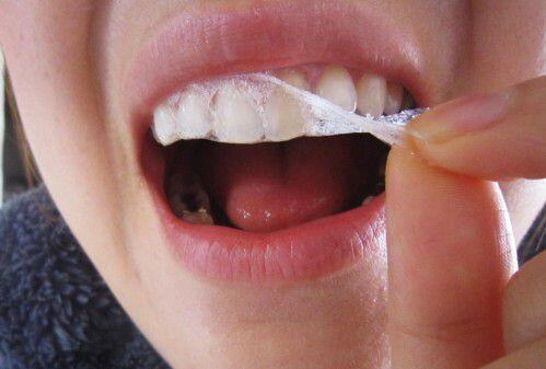 Sau khi tẩy trắng răng bị ê buốt là vì sao ?