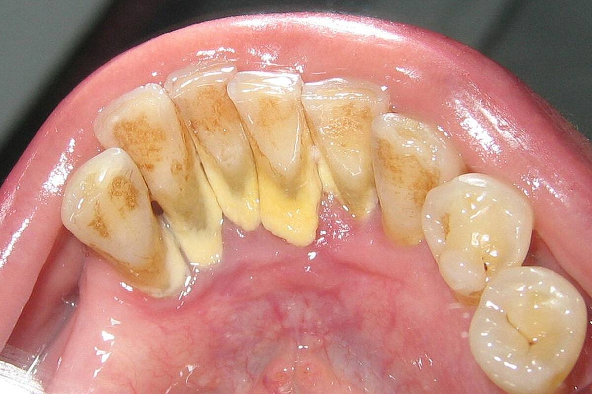 Cao răng nguy hiểm thế nào tới sức khỏe răng miệng ?