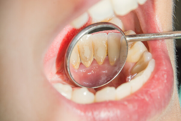 Làm gì để phòng ngừa sự hình thành cao răng hiệu quả?-2