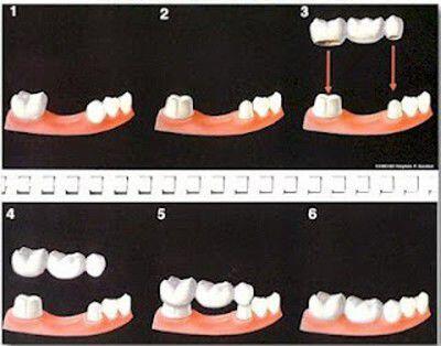 Giải pháp làm cầu răng sứ dành cho nhiều bệnh nhân-1