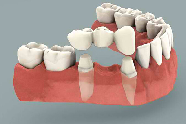 Có thể làm cầu răng thay thế cho Implant được không?-1
