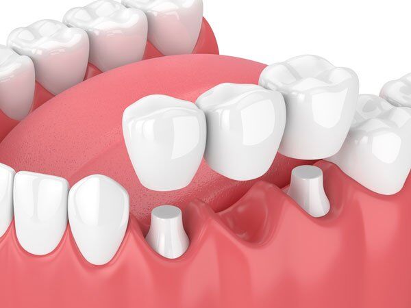 Trồng răng giả có ảnh hưởng gì không ?