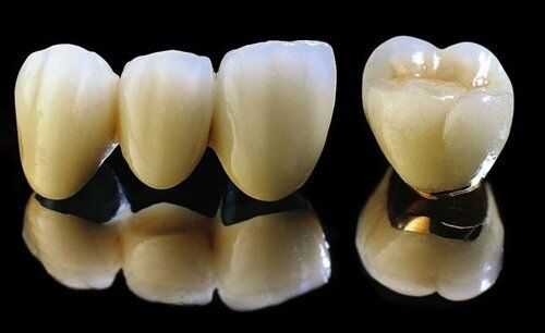 Răng sứ kim loại là gì?-1