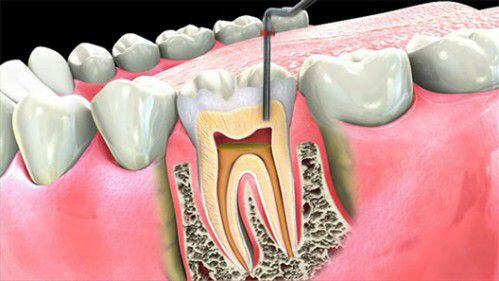 Bệnh viêm tủy răng nguy hiểm tới mức nào?
