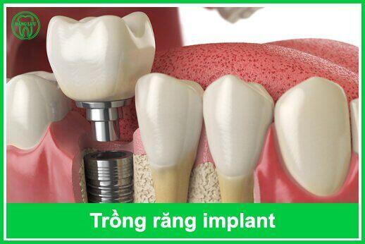 Chi phí trồng răng Implant