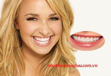 Các loại niềng răng thẩm mỹ hiện nay-1