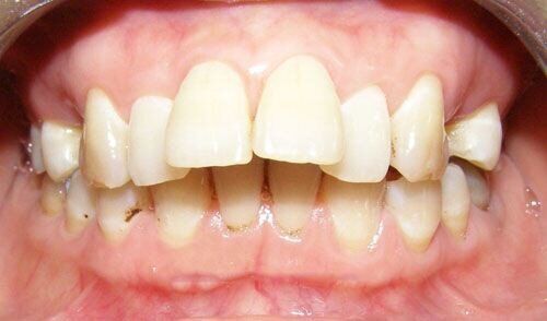 Răng hô có di truyền không ?
