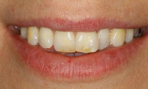 Bọc răng sứ cho tình trạng thiếu sản men răng