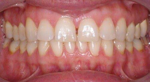 Có cách điều trị dứt điểm để bệnh thiếu sản men răng không ? 3