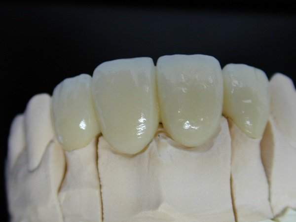 Có nên bọc răng sứ Titan cho răng hàm bị sâu hay không?