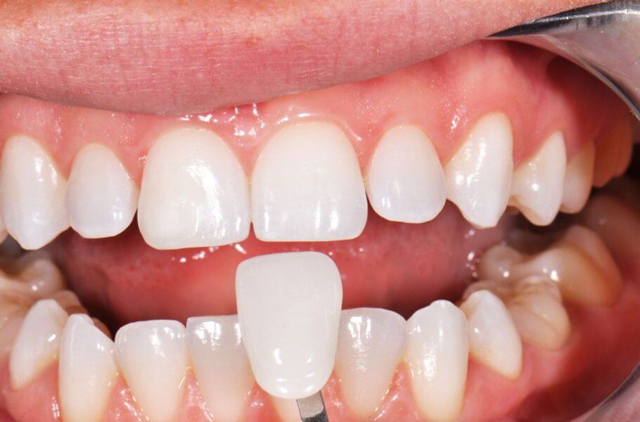 Răng sứ Veneer mỏng nhẹ và có tính thẩm mỹ cao
