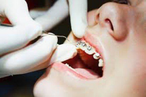 Hiệu quả của niềng răng - Lý do bạn nên niềng răng ngay