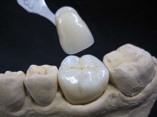 Bọc răng sứ Lava Plus duy trì được bao lâu?