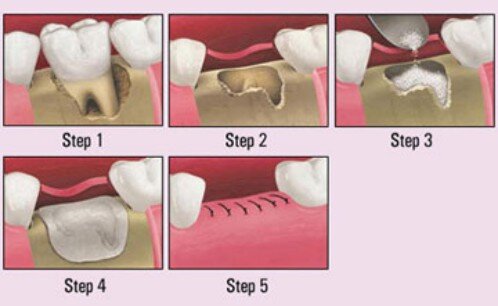 Ghép xương và nâng xoang hàm trong trồng răng implant-1