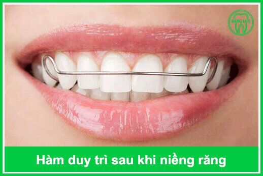Nhiệm vụ của hàm duy trì sau niềng răng-1