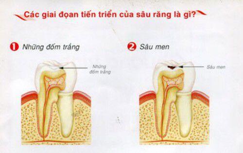 Tại sao nên nhổ răng sâu
