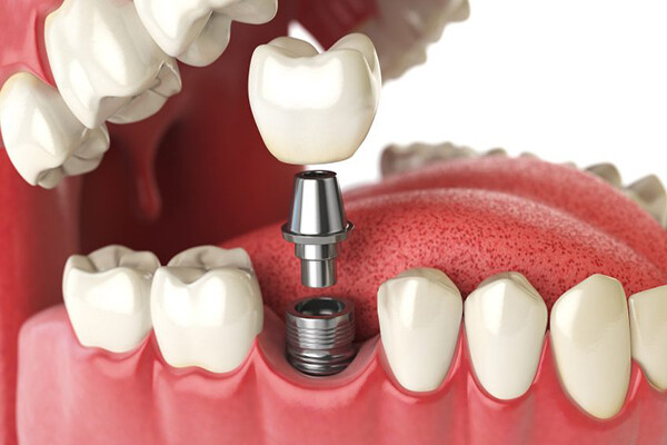 Có thể làm cầu răng thay thế cho Implant được không?-2