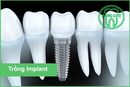 Implant osstem và một số trụ Implant được dùng phổ biến-1