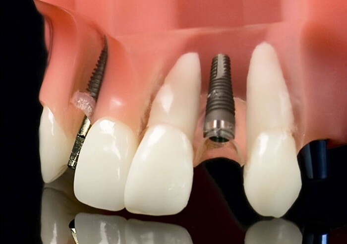 Kỹ thuật cắm ghép răng thường gặp