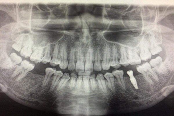 Cầu răng có thể ngăn được tình trạng tiêu xương không?