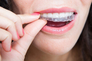 Tầm quan trọng của khí cụ duy trì trong niềng răng