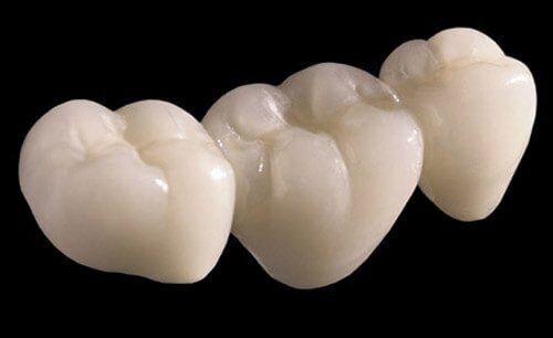 Khi nào nên bọc răng sứ Cercon?