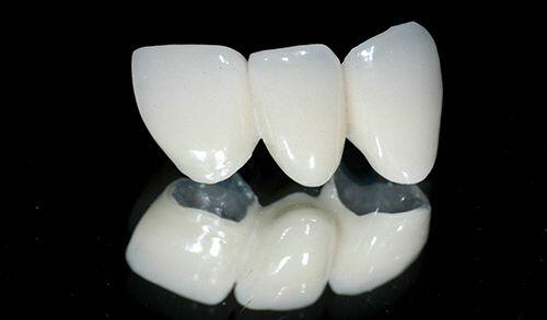 Khi nào nên bọc răng sứ kim loại?