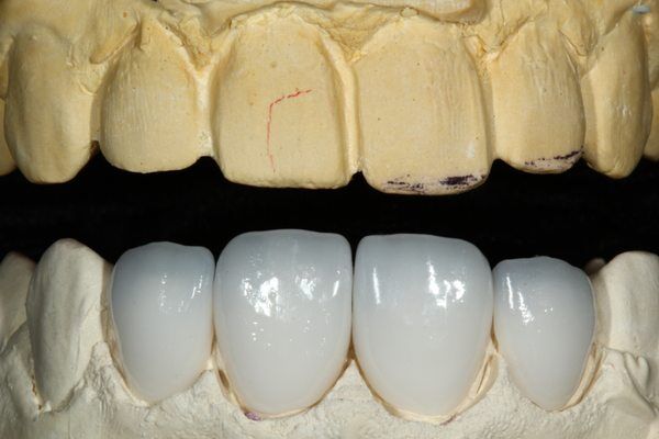 Khi nào nên bọc răng sứ phục hình răng hiệu quả?