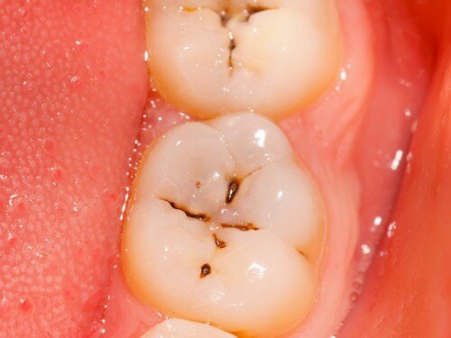 Làm sao để bảo vệ răng bị sâu