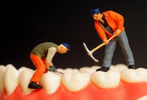 Trám răng có phải là giải pháp tối ưu cho răng sâu