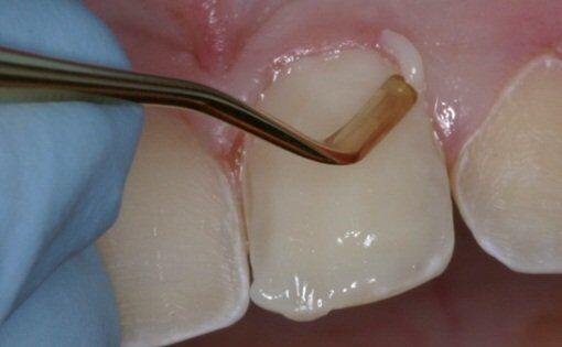 Làm răng sứ Direct Veneer có đau không?