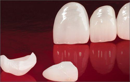 Làm răng sứ Veneer ở đâu tốt an toàn và hiệu quả?