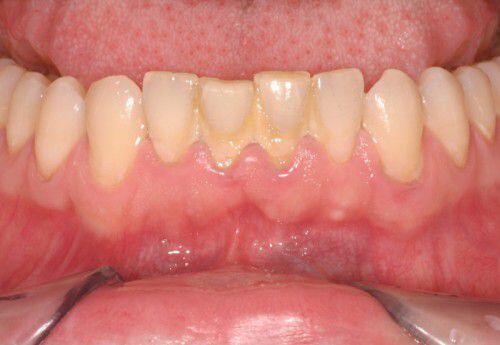 Nguyên nhân khiến răng bị mòn mặt nhai