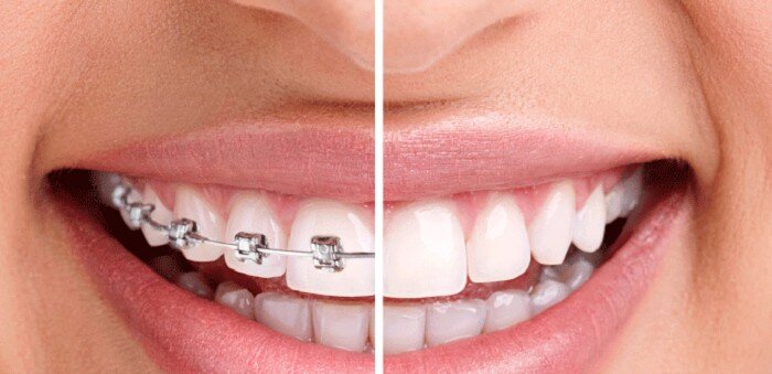 Tổng hợp lợi ích từ việc niềng răng chỉnh nha-1