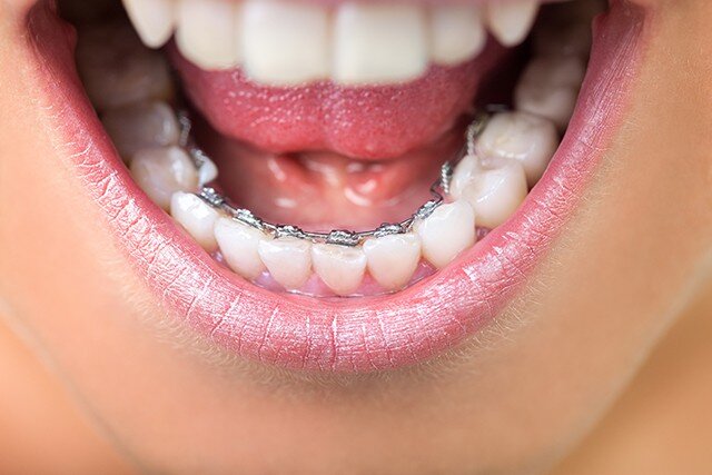 Tổng hợp lợi ích từ việc niềng răng chỉnh nha-2
