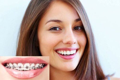 Tổng hợp lợi ích từ việc niềng răng chỉnh nha-3