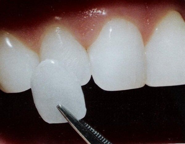 Mặt dán sứ Veneer có phải là cách thẩm mỹ răng tốt?