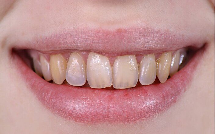Các yếu tố ảnh hưởng đến men răng-1