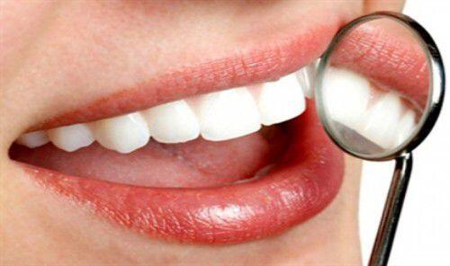 Có những phương pháp tẩy trắng răng nào ?