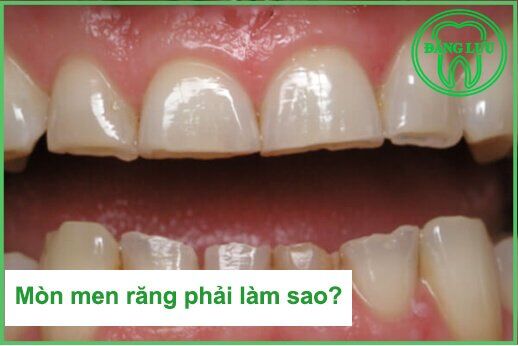 Những vị trí dễ bị mòn men răng trên khuôn hàm nhất-1