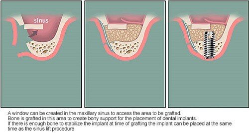 Tại sao cần nâng xoang hàm trong cấy ghép implant-1