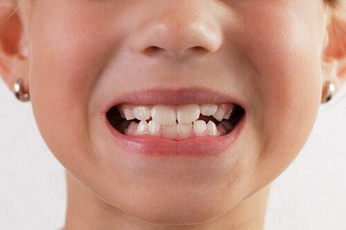 Nghiến răng ảnh hưởng thế nào tới sức khỏe răng miệng?-3