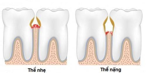 Xỉa răng ảnh hưởng thế nào tới sức khỏe răng miệng