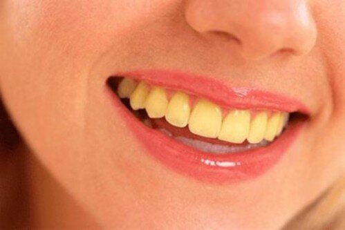 Nguyên nhân khiến răng bị ố vàng-1