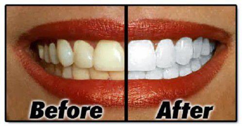 Răng bị xỉn màu có nên tẩy trắng không ?