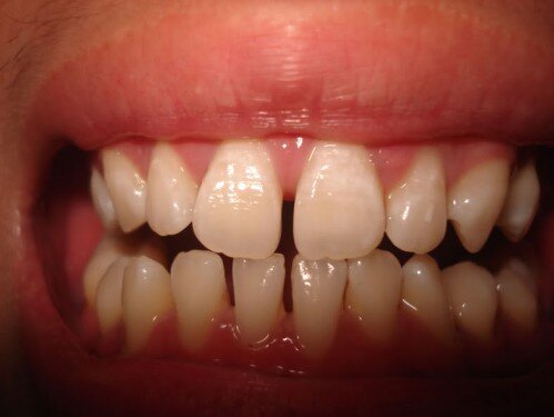 Nguyên nhân dẫn tới tình trạng thưa răng